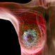 featured-breast-cancer